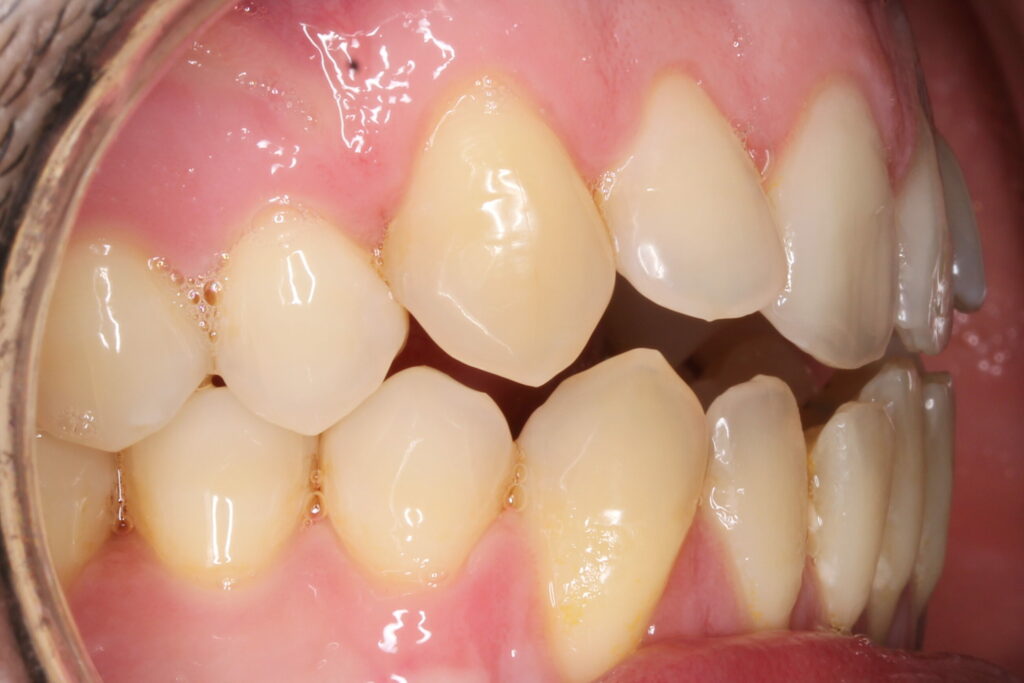 Mordida abierta anterior