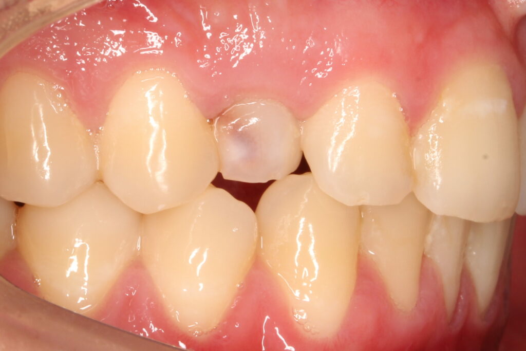 Dientes de leche y definitivos , ¿distingues cuales son?