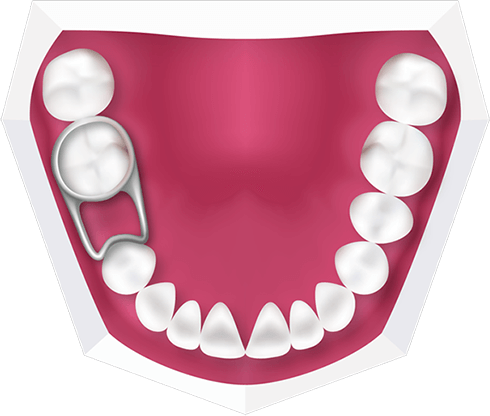 Ortodoncia interceptiva, ¿para qué sirve?