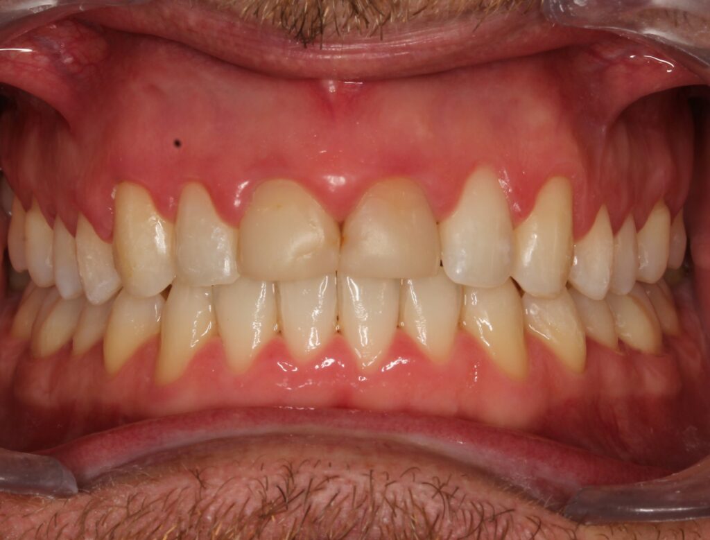 Carillas dentales en Murcia