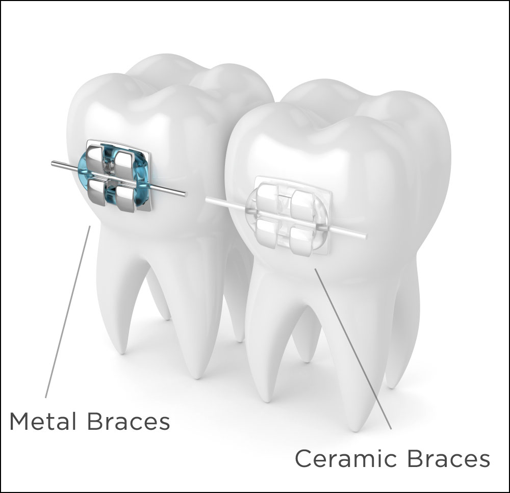 Brackets Cerámicos