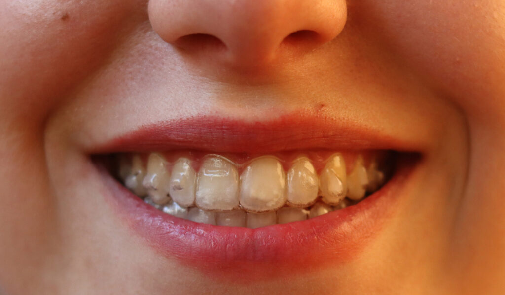 Piercings en la boca y ortodoncia invisible: ¿Son compatibles?