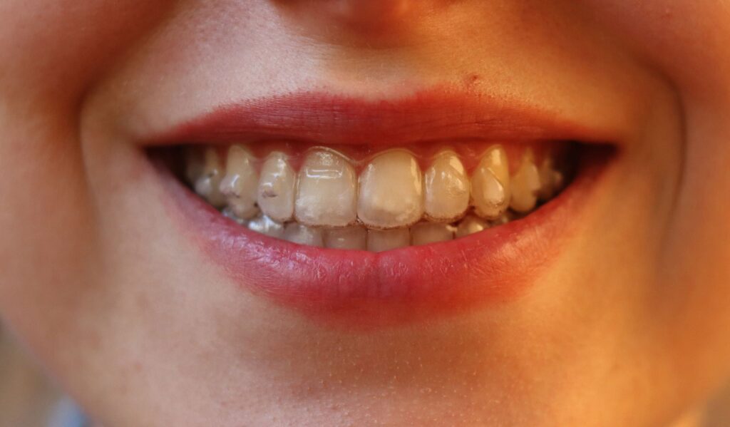 Ortodoncia Invisible y Blanqueamiento Dental, orden Correcto para Resultados Perfectos