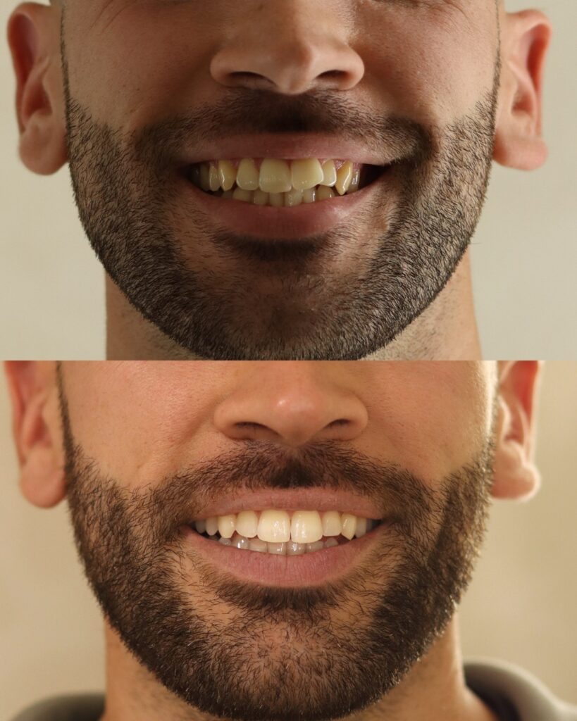 Manuel, apiñamiento antes y después con ortodoncia invisible. Caso real de Ortodoncia Lozano (Murcia)