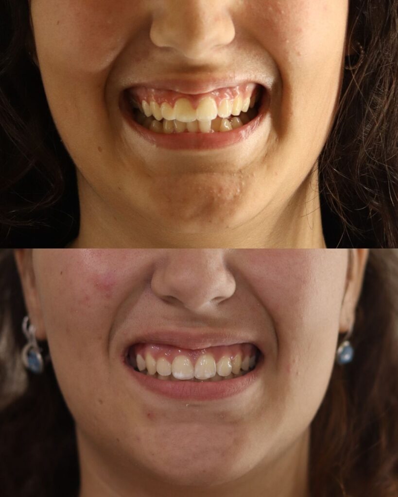 Andrea, antes y después. Caso real de Ortodoncia Lozano (Murcia)