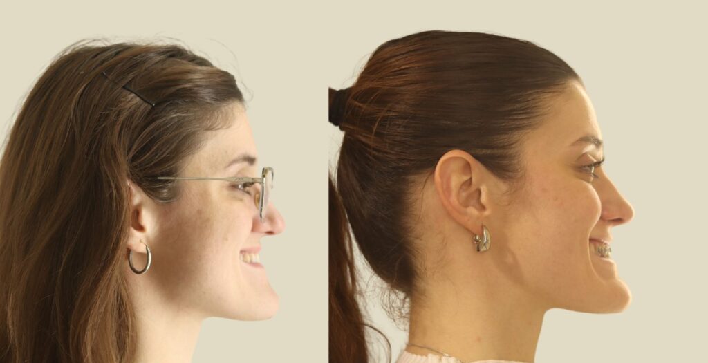 Laura · perfil antes y después con MARPE, sin cirugía