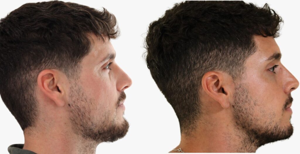 Javier · perfil antes y después
