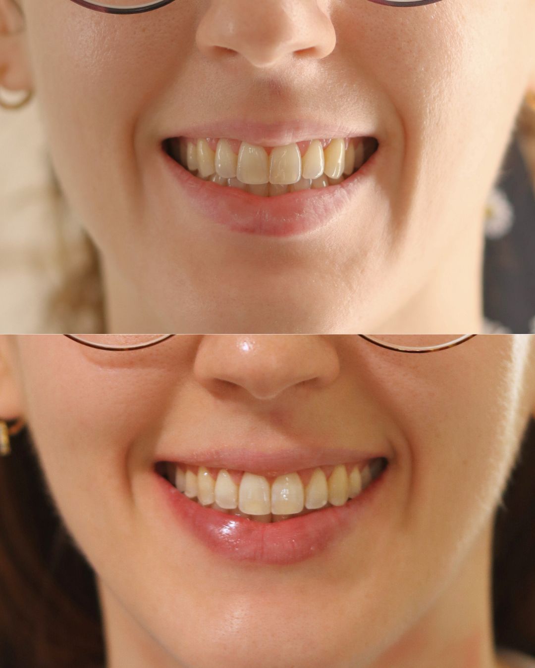 Lorena, antes y después. Caso real de Ortodoncia Lozano (Murcia)