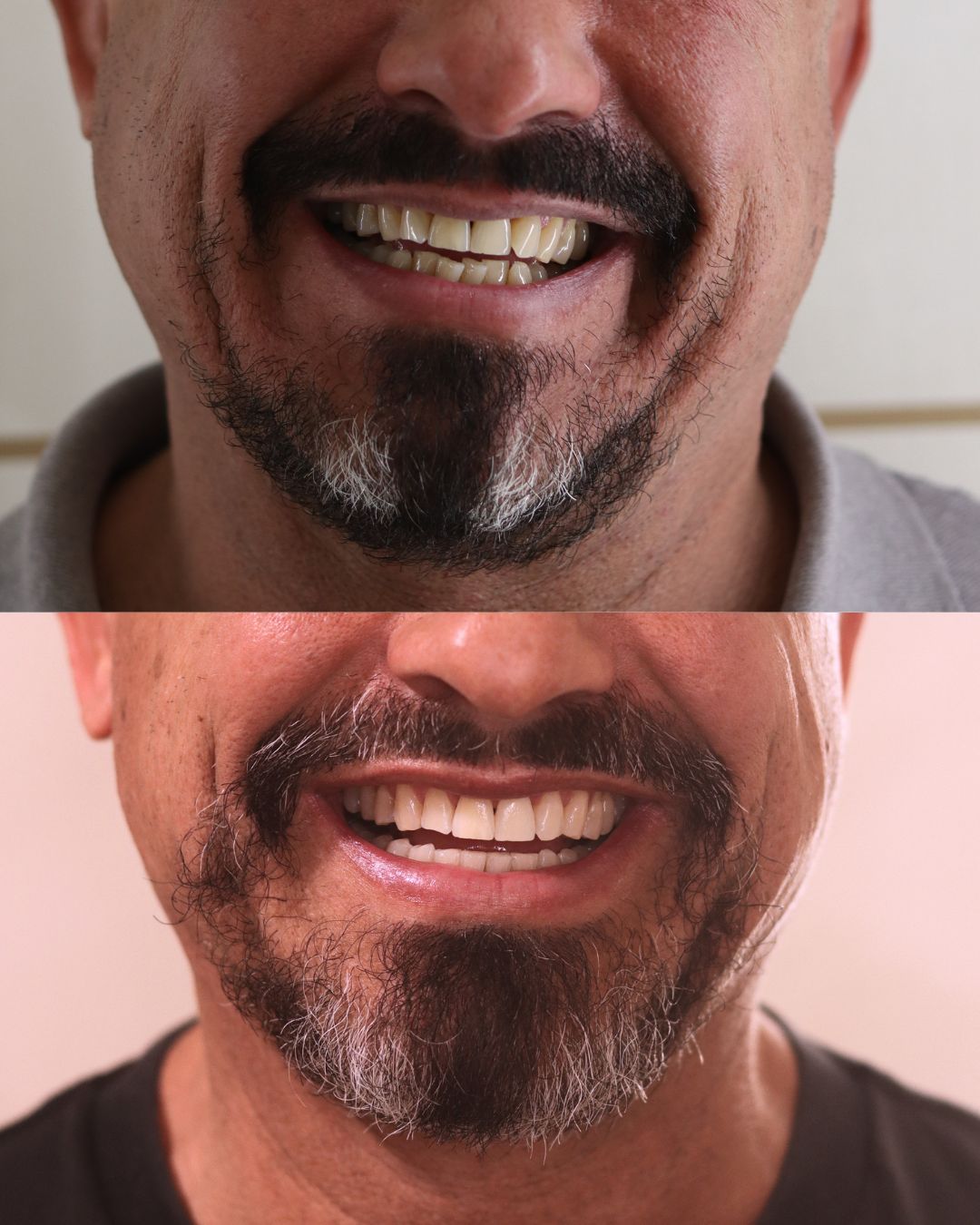 Juan, antes y después. Caso real de Ortodoncia Lozano (Murcia)