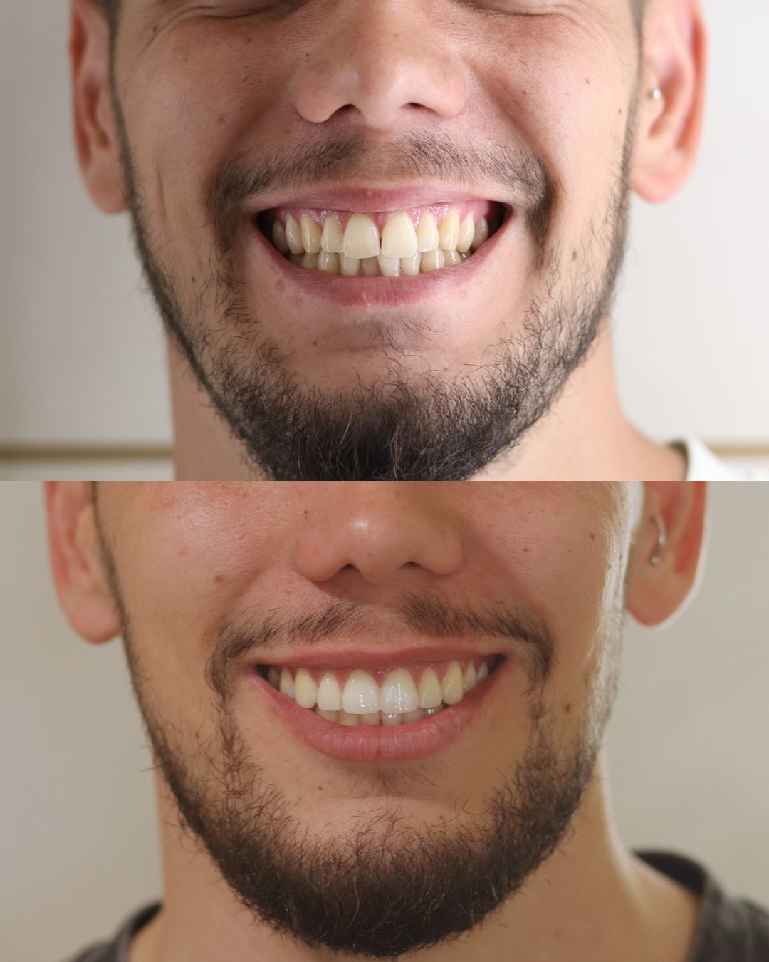 Manuel · apiñamiento antes y después con ortodoncia invisible
