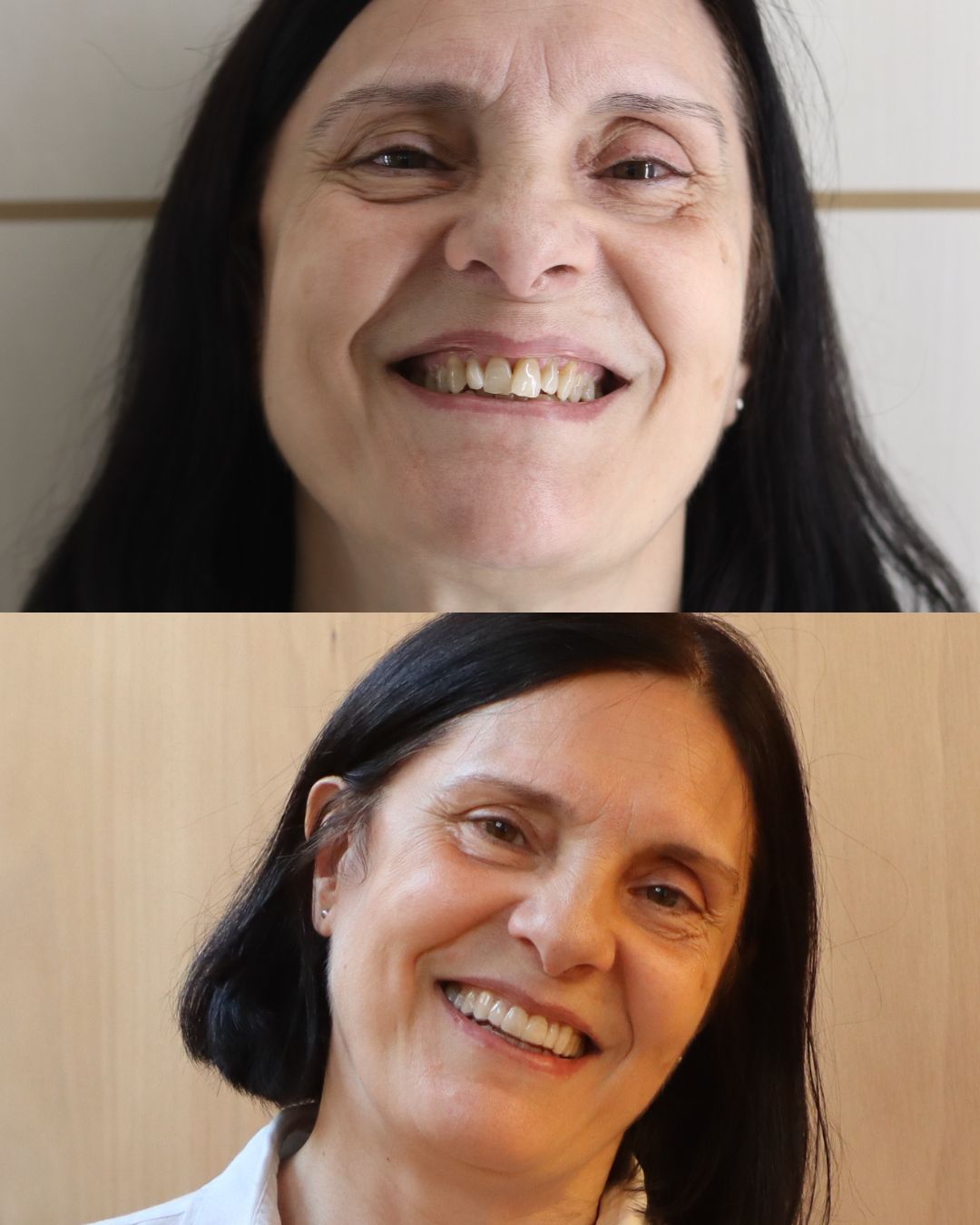 Caso real de más de 40 años: antes y después con ortodoncia invisible