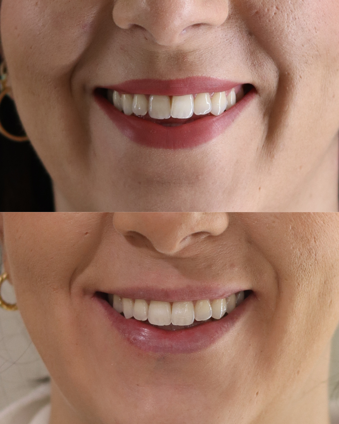 Andrea · sobremordida antes y después con ortodoncia invisible
