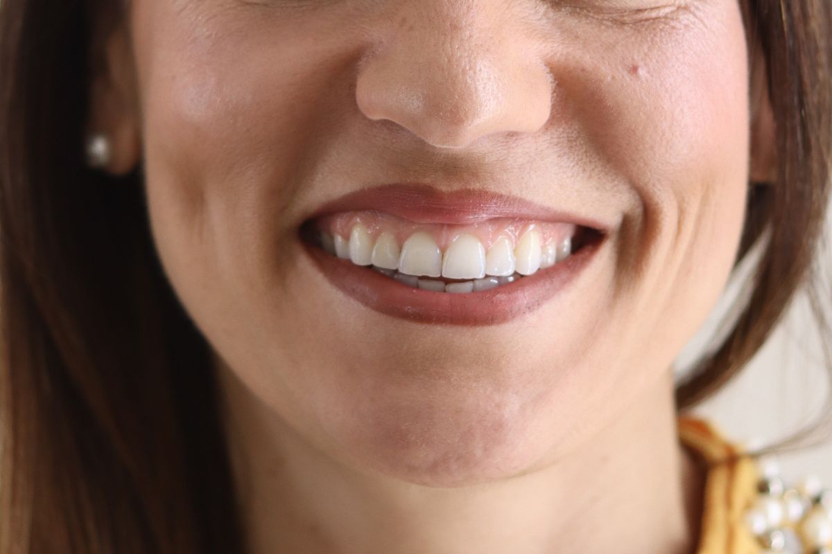 Antes: apiñamiento dental previo al tratamiento