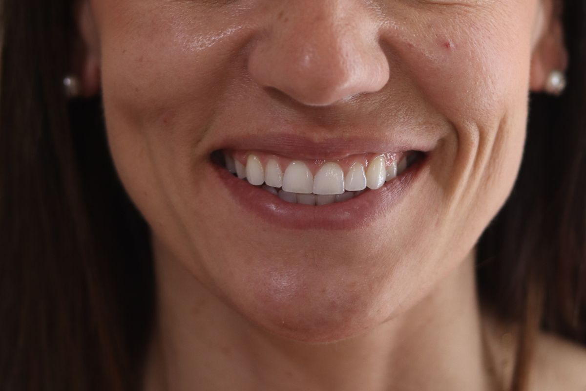 Después: sonrisa alineada tras ortodoncia invisible