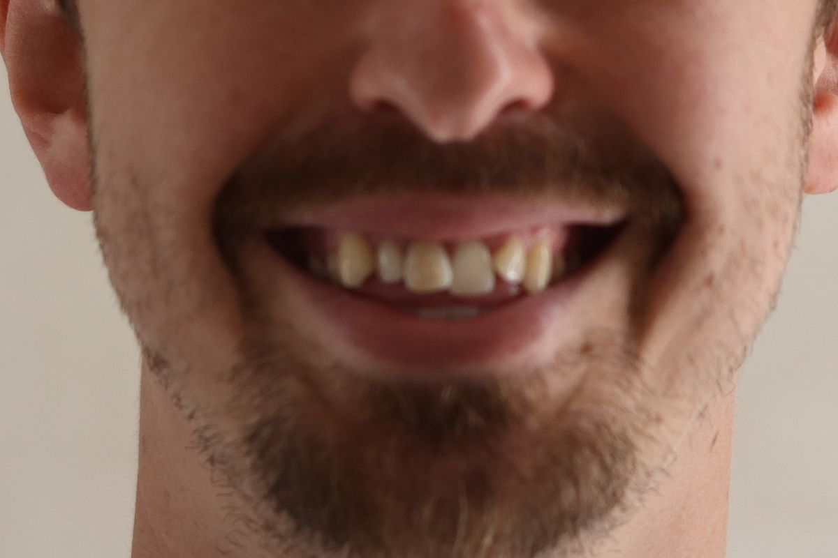 Antes: dientes apiñados antes de la ortodoncia