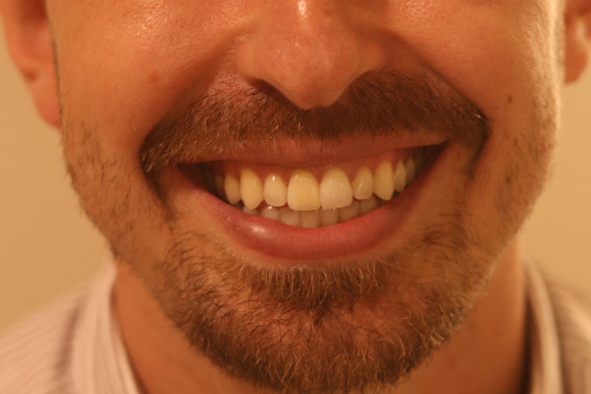 Después: sonrisa alineada con ortodoncia invisible