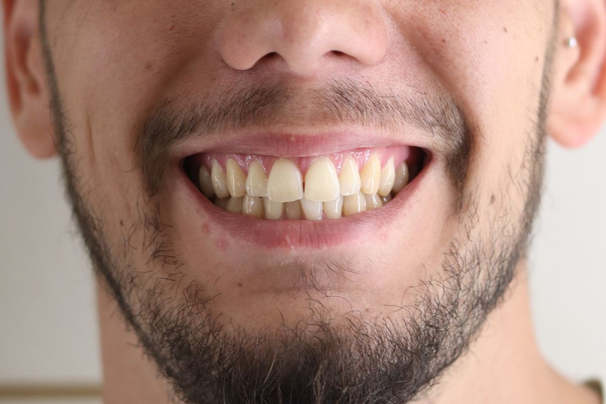 Antes: espacios entre los dientes antes del tratamiento