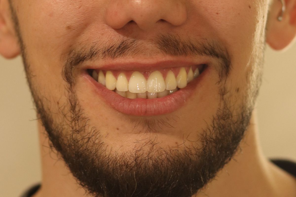 Después: sonrisa cerrada y alineada con ortodoncia invisible