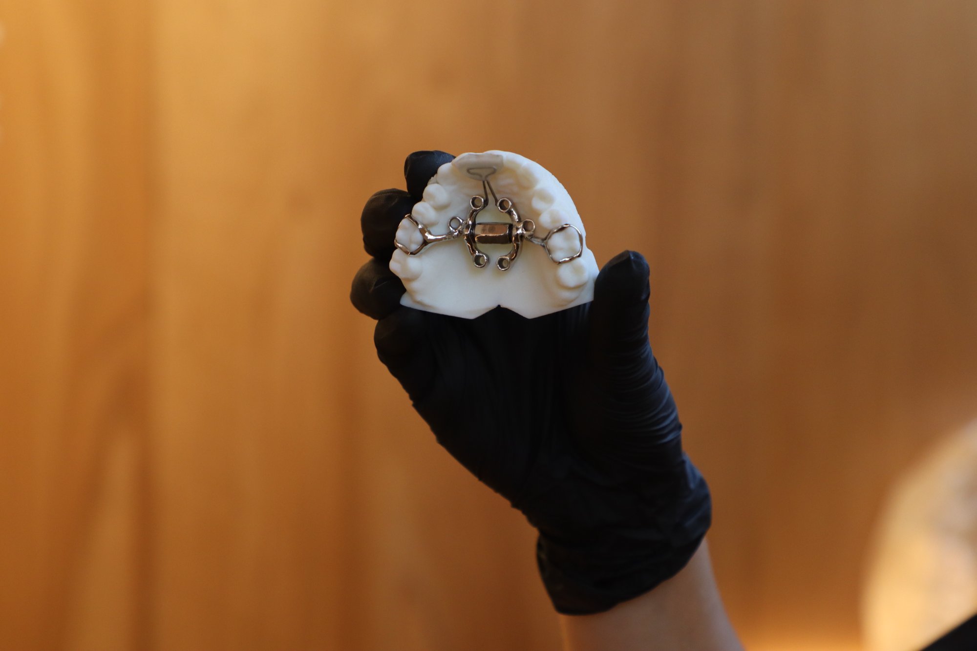 Expansor MARPE anclado a un modelo dental