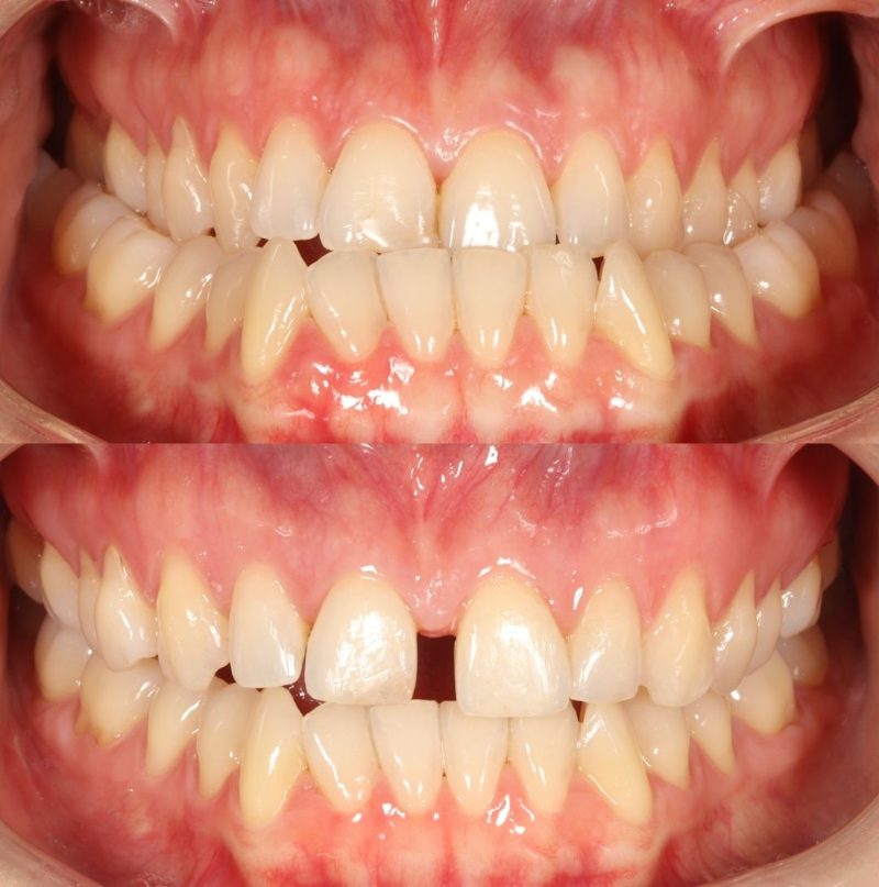 Antes y después de un caso real de MARPE
